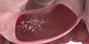 Upotreba trojki za uklanjanje parazita