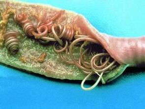 Uzroci parazita u ljudskom tijelu